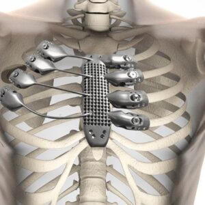 3D Printed Implants Market